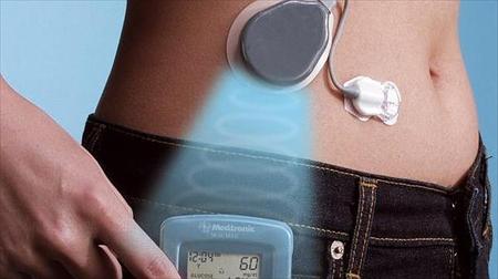 La bomba de insulina, más eficaz que las inyecciones para la diabetes infantil