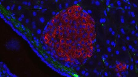 La diabetes se podría revertir con la pérdida de un único gramo de la grasa del páncreas