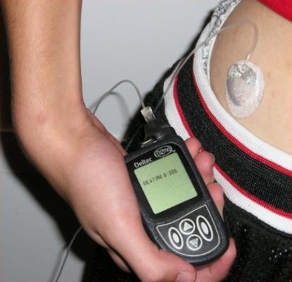 El páncreas artificial, mejor que la bomba de insulina